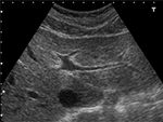 肝臓の超音波画像