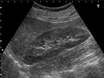 腎臓の超音波画像