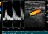 頸動脈の超音波画像
